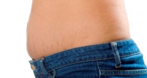 Does Surgery Really Cure Stretch Marks?