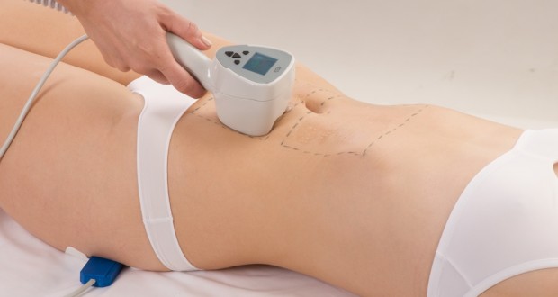 Get Rid of Striae With New Fractional Laser Treatment