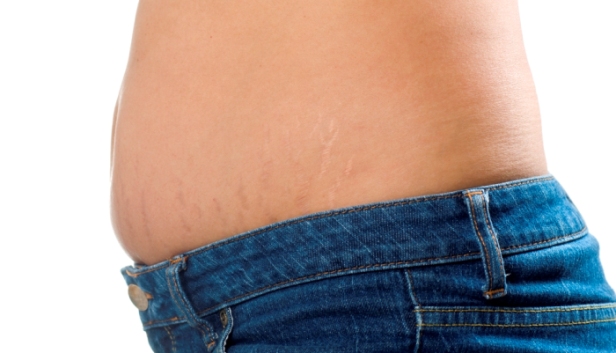 Does Surgery Really Cure Stretch Marks?